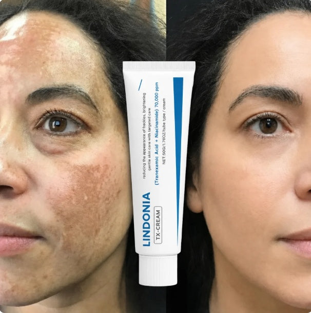 Lindonia® Corrector de Manchas